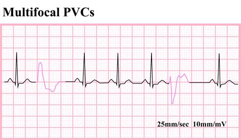 ventricular ectopics ecg images